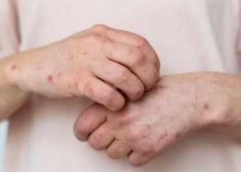 Quintana Roo resiste al brote nacional de sarampión, sólo 5 casos confirmados