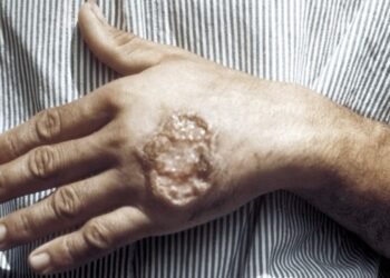 ¿Por qué preocupa la leishmaniasis en Quintana Roo? Ya es el estado con más contagios del país