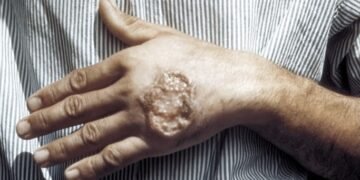 ¿Por qué preocupa la leishmaniasis en Quintana Roo? Ya es el estado con más contagios del país