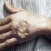 ¿Por qué preocupa la leishmaniasis en Quintana Roo? Ya es el estado con más contagios del país