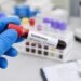 Cinco muertes bajo investigación sanitaria en Venezuela; tres casos fueron confirmados como Hantavirus